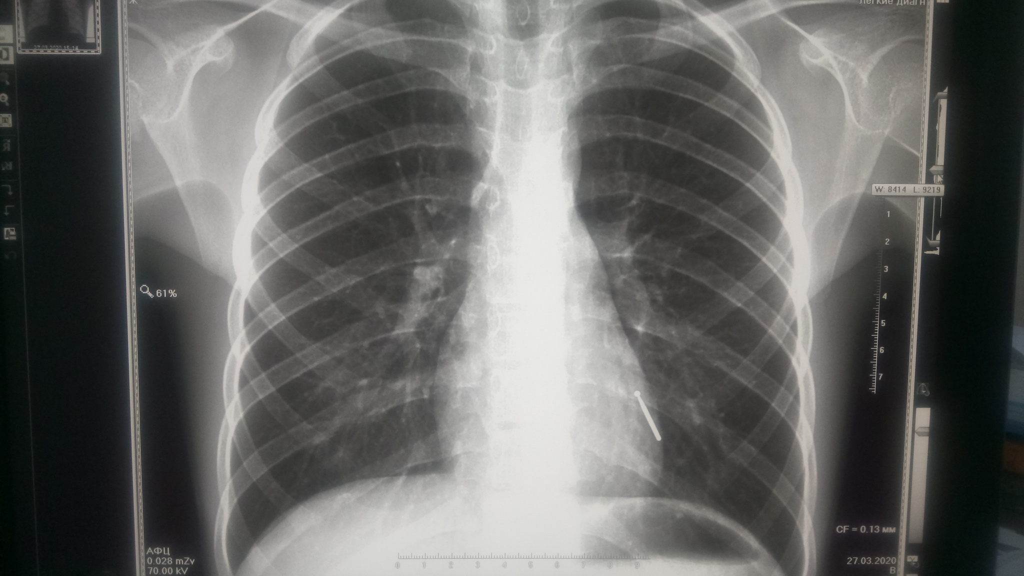 Инородные тела верхних дыхательных путей рентген